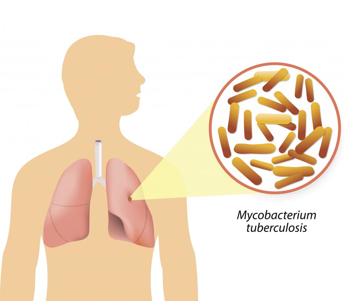 Pharmacist: Basics Of TB And NTEP | Knowledge Base